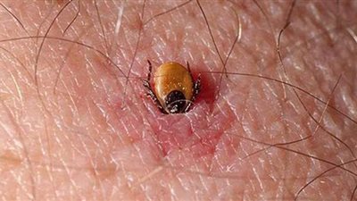 لدغات القراد.. عدوى فيروسية تصيب الإنسان بالشلل