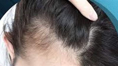 استشاري يوضح كيفية زراعة الشعر للنساء بدون حلاقة