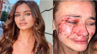 تشوه وجه عارضة أزياء أوكرانية على يد رجال الأمن في تركيا