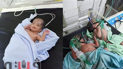 أنجبت 3 توائم..  ولادة قيصرية لمريضة مصابة بكورونا في بني سويف | صور