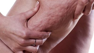 أسباب السيلوليت وطرق التخلص منه