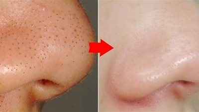 نصائح ووصفات من الطبيعة للتخلص من الرءوس السوداء