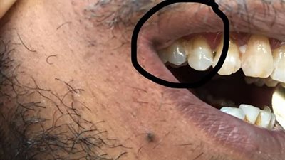 شاهد.. ما فعله «بواب» لحشو ضرسه بمساعدة «نقاش»