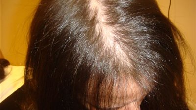 «فيتامين c» للقضاء على «الثعلبة والصلع»