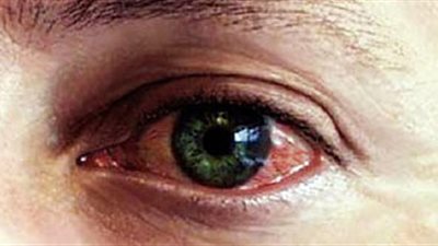 6 أسباب تؤدي إلى الإصابة بإفرازات العين الصديدية