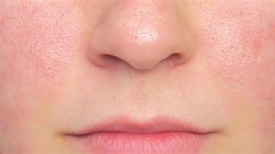 قناع الفحم بالألوفيرا حل سحري لشد البشرة وتضييق المسام