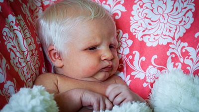 بالصور.. حالة نادرة تتسبب في ولادة طفلة بالشعر الأبيض