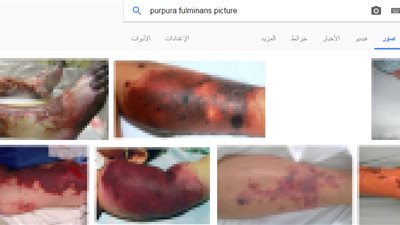 مرض «فرفرية الصاعقة» آخر ما بحثت عنه «منى بكر» قبل وفاتها