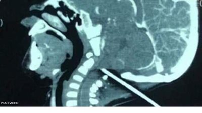 قضيب حديدي يخترق جمجمة رضيع.. و