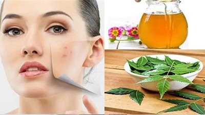 7 أعشاب ومواد طبيعية تخلصك من حب الشباب