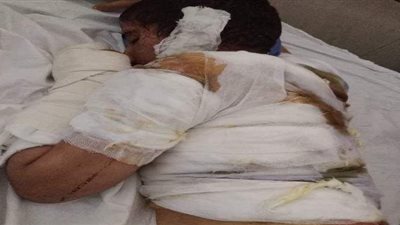 قطع أذن طفلة وحرق جسدها بالكلور على يد سيدة وزوجها بطنطا