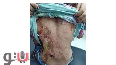 خادمات البيوت من الأطفال.. حرق 