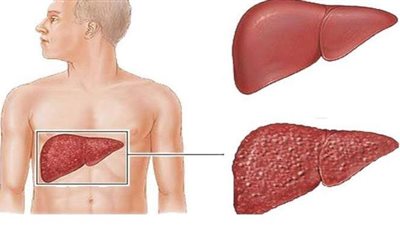 كيف تحدث الإصابة بالتهاب الكبدي 