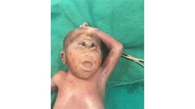 ولادة طفل بتشوه خلقي 