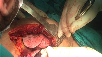 بالصور.. المستشفى التعليمي بالمنوفية تنجح في إعادة قلب مريض للحياة