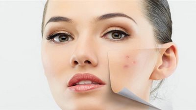 ماسك طبيعي يخلصك من حب الشباب نهائيا