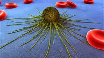 «السرطان» في أرقام.. وفاة 19 مليون حالة كل عام.. نسبة الشفاء في مصر 74.3%.. 42% من المرضى أطفال.. والتدخين والمبيدات وفيروس c وعدم الحركة من مسببات المرض
