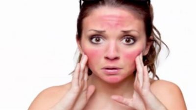 جل الصبار لتخليص البشرة من حروق الشمس