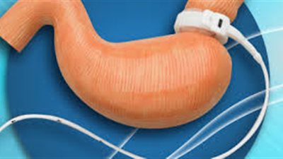 دراسة: جراحات السمنة تقلل من مخاطر أمراض القلب بين المراهقين