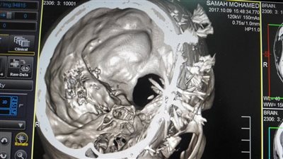 استخراج 52 طلقة خرطوش من رأس طفل في دمياط