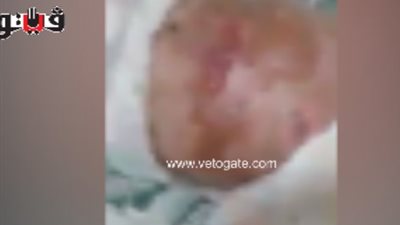 بالفيديو.. مأساة طفلة تعانى من مرض نادر يحرق جسدها بالشرقية