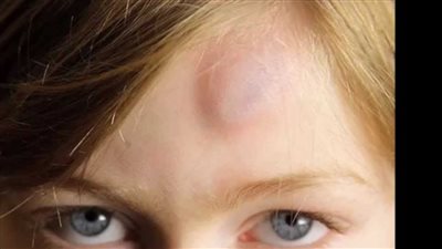 ظهور الكدمات لدى الأطفال مؤشر على الإصابة بأمراض خطيرة