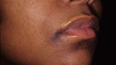 أقنعة «الدقيق والبازلاء» لعلاج اسمرار الذقن وحول الشفاة