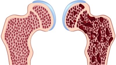 بالفيديو.. 10 أطعمة تحمي من الإصابة بهشاشة العظام