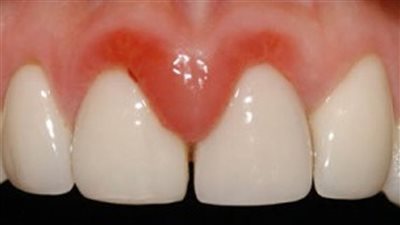 أمراض اللثة مرتبطة بزيادة حدة الإصابة بالسرطان بين النساء الأكبر سنا