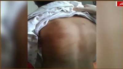 طفلة: جوز أمي بيرمي الزيت المغلي على إيدي وبيطفي السجاير في جسمي