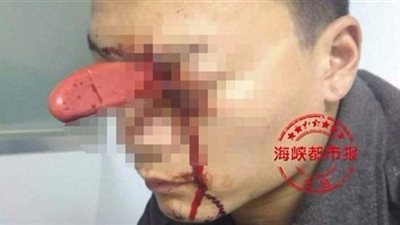 زوجة تغرس سكين مطبخ في عين زوجها خلال مشاجرة عائلية