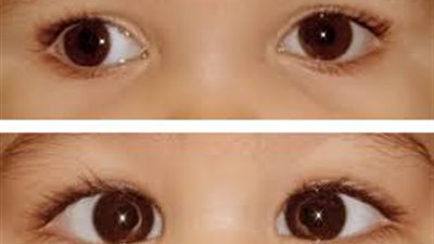 «بحوث العيون» يكشف أسباب انتشار مرض حول الأطفال