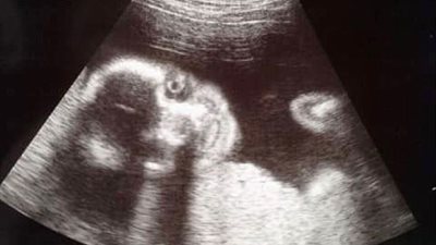 أغرب صورة جنين داخل رحم أمه (صور)