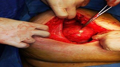 طاقم طبي يستأصل ورم يزن ١٠ كيلو جرام  بمستشفى طنطا