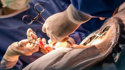 إجراء قيصرية نادرة لسيدة تحمل 