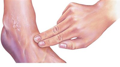 أستاذ أوعية: التشخيص المبكر للقدم السكري يساعد على علاجها دون بتر