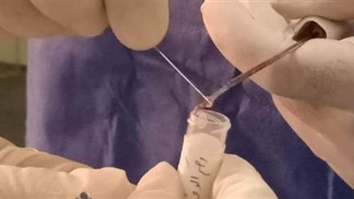 3 عمليات جراحية لاستئصال الثدي.. وفحص 21 سيدة إكلينيكا بالشرقية ضمن المبادرة الرئاسية