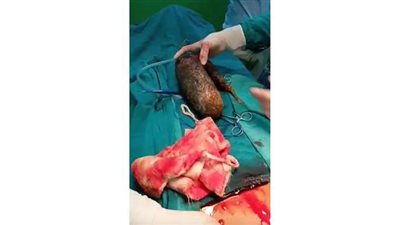 إزالة كرة شعر تزن 7 كجم من معدة فتاة في الهند