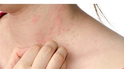 اكتشف أنواع حساسية الجلد خلال الصيف .. وطرق العلاج