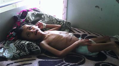 «مهند» طفل يأمل في الحياة بمستشفى أطفال المنصورة