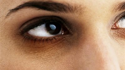 أسباب الإصابة بهالات العين السوداء وطرق علاجها