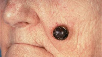 حسنات الجسم ناقوس خطر يهدد الصحة.. «الشاعر»: دليل على الإصابة بالأورام والخوف من تطورها.. «الناظر»: تظهر لأصحاب البشرة البيضاء ويمكن إزالتها بالليزر.. و«زخاري» تكشف أنواع