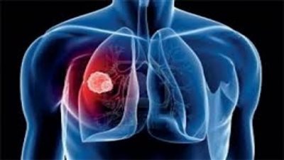 دراسة: مرضى سرطان الرئة لديهم ميول انتحارية