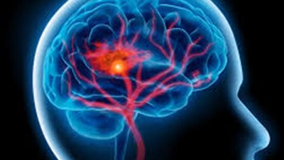 طرق الإسعافات الصحيحة للتعامل مع المصاب بانفجار الدماغ