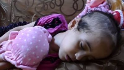 بيان عاجل ضد وزير الصحة بعد وفاة «جنى» ضحية السرطان