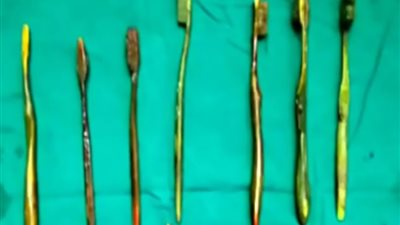 بالصور.. فتاة حاول أهلها إجبارها على الزواج فابتلعت 7 فرشات أسنان