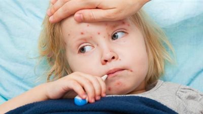 ارتفاع الإصابة بالحصبة في بريطانيا لـ 120 حالة