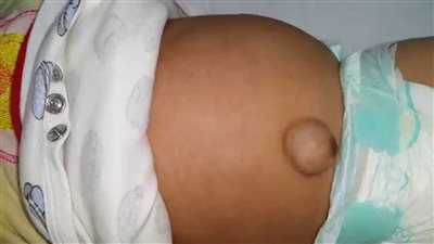 للامهات.. أسباب الفتق السري عند الأطفال وطرق التعامل معه