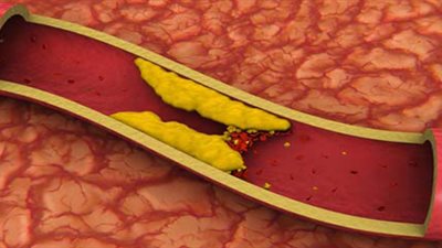 استشاري أوعية دموية يوضح أنواع الكوليسترول وطرق العلاج من أضرارها