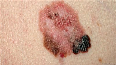 دراسة: كريمات الحماية لا تقي من سرطان الجلد الأسود